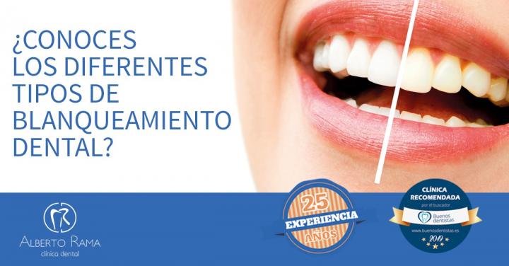 GUÍA COMPLETA SOBRE EL BLANQUEAMIENTO DENTAL | Buenosdentistas